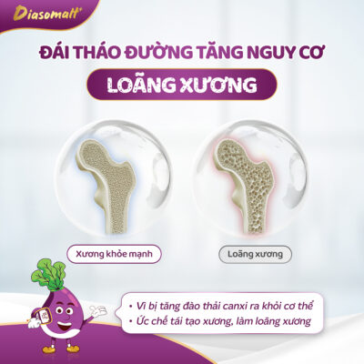 Đái tháo đường tăng nguy cơ loãng xương